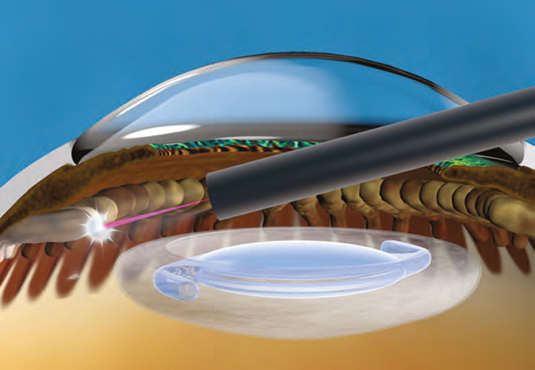 Combination MIGS Thumbnail