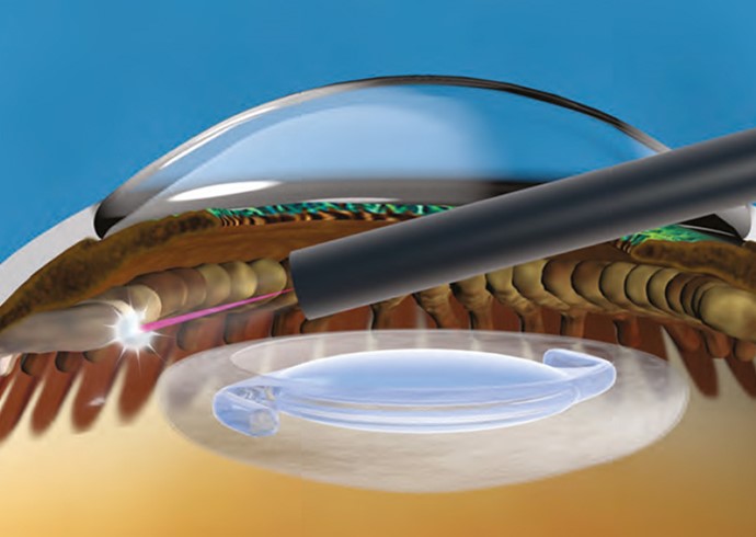 Combination MIGS Thumbnail