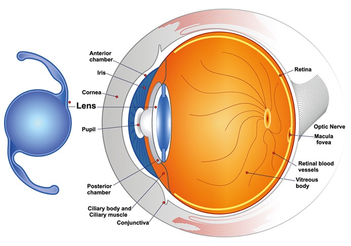 Cataract Diagram