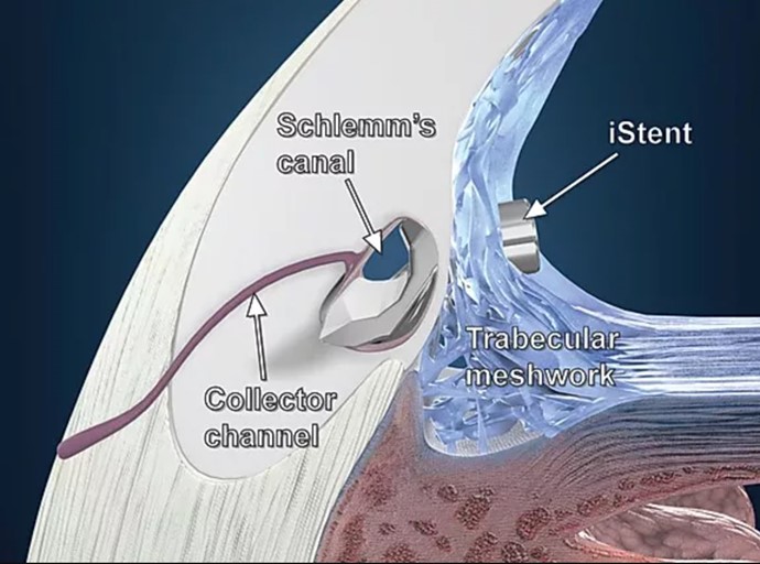 iStents inserted through the trabecular meshwork