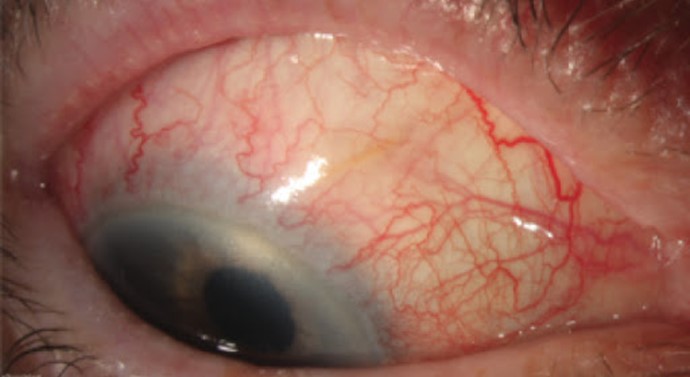 Sub-conjunctival bleb with Xen gel stent.