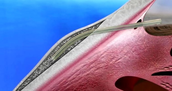 Xen stent in subconjunctival space.