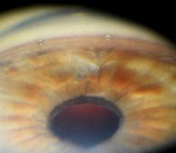 Intra-operative gonioscopic view of the iStents